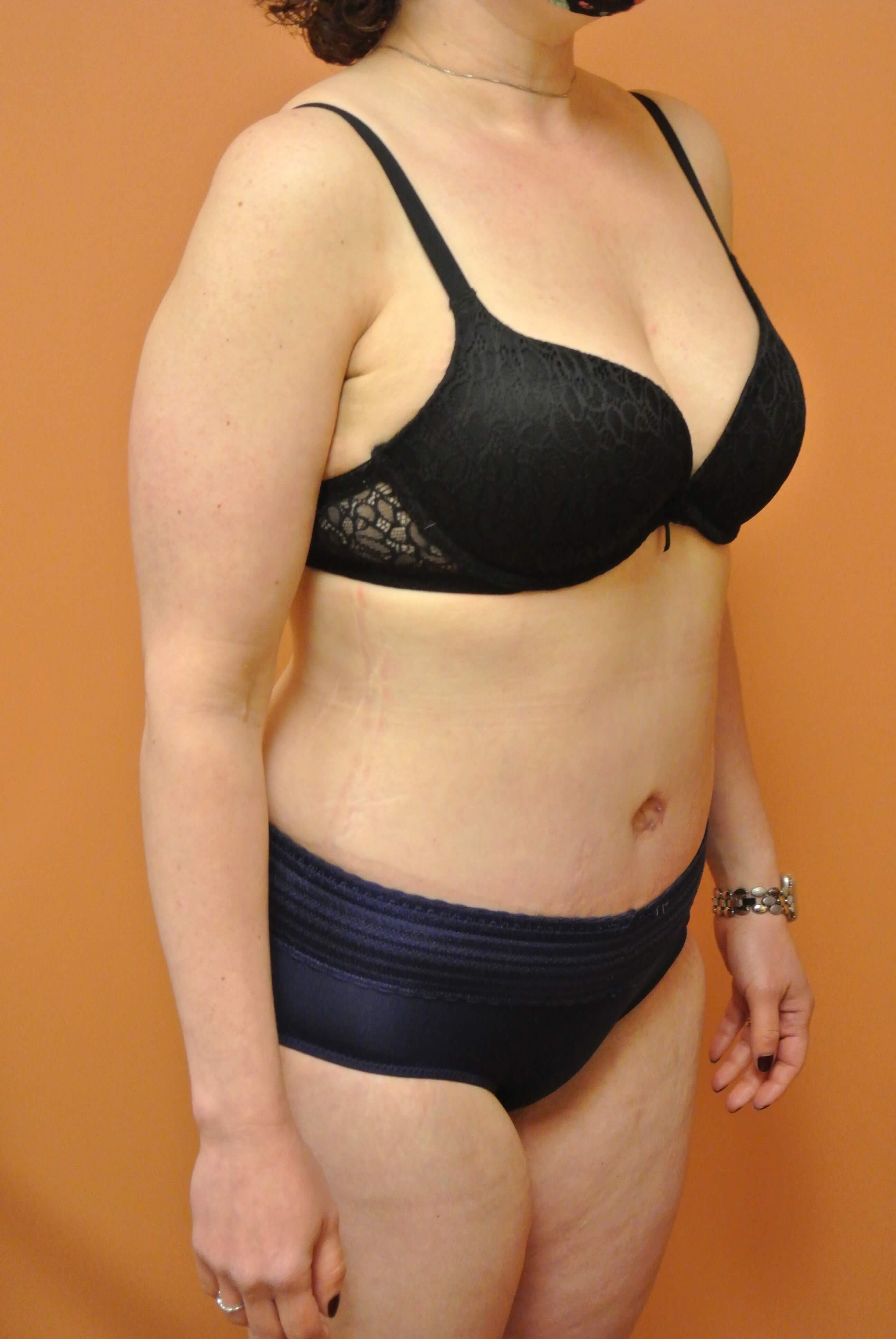 Mommy Makeover Tummy Tuck After Tummy Tuck