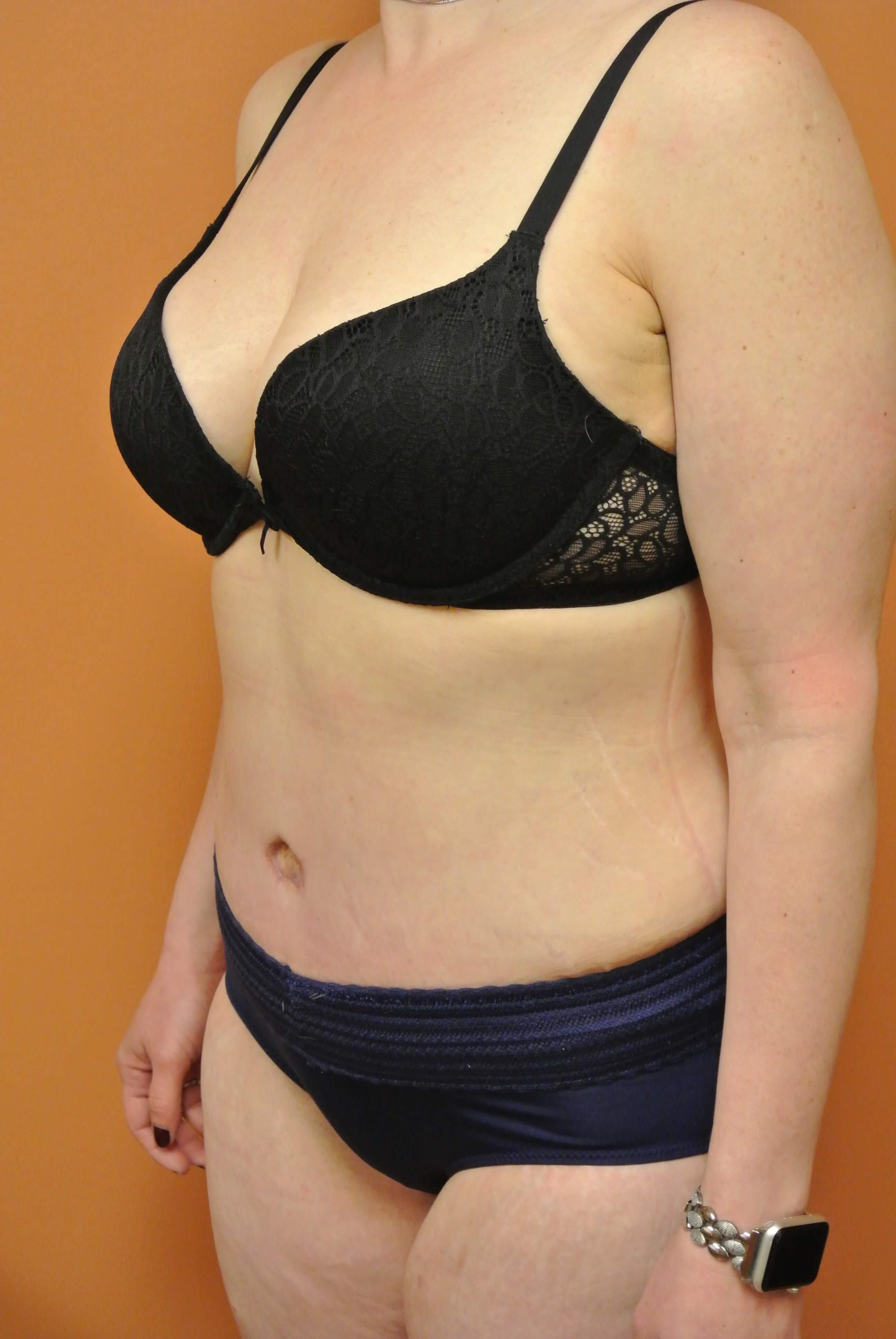 Mommy Makeover Tummy Tuck After Tummy Tuck