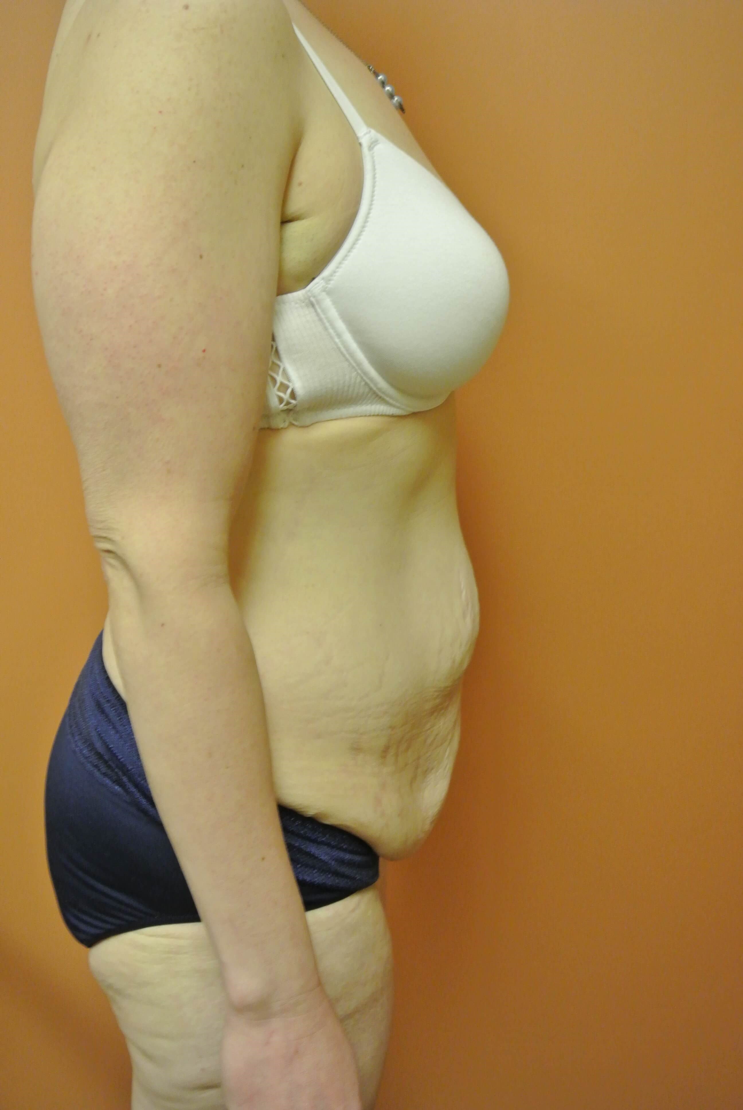 Mommy Makeover Tummy Tuck Before