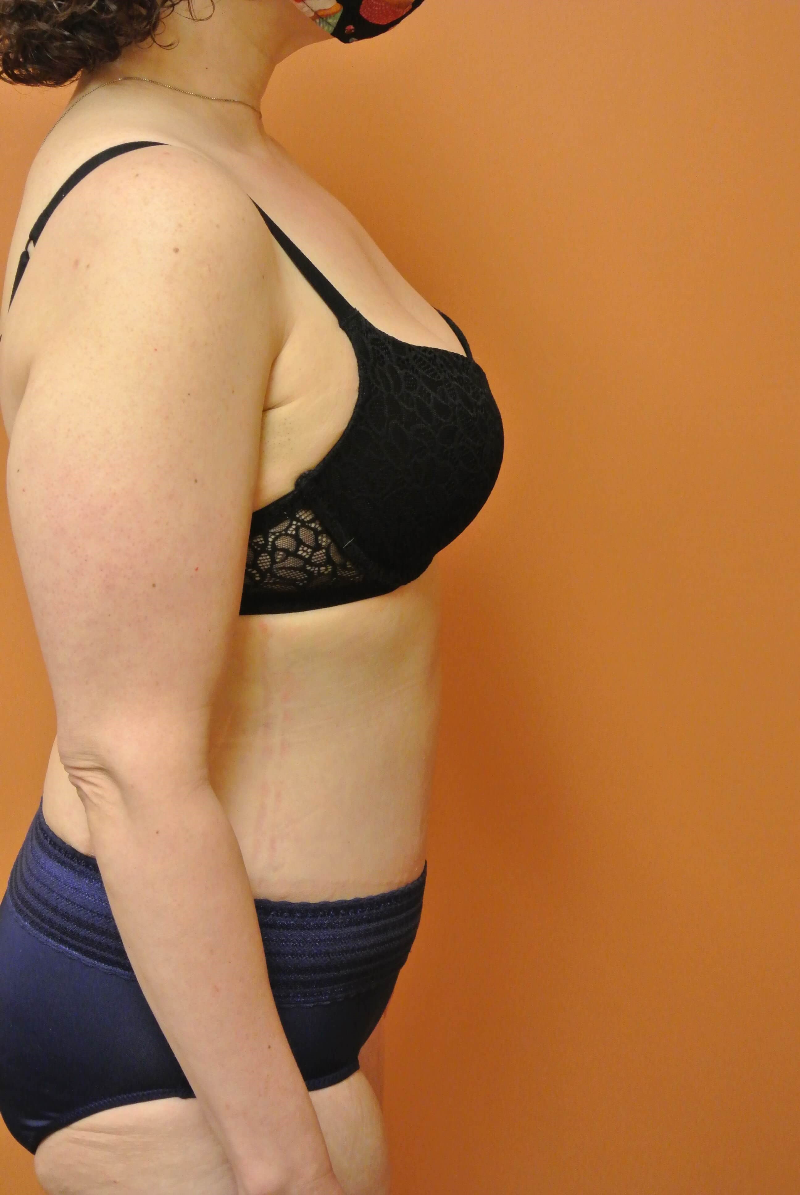 Mommy Makeover Tummy Tuck After Tummy Tuck