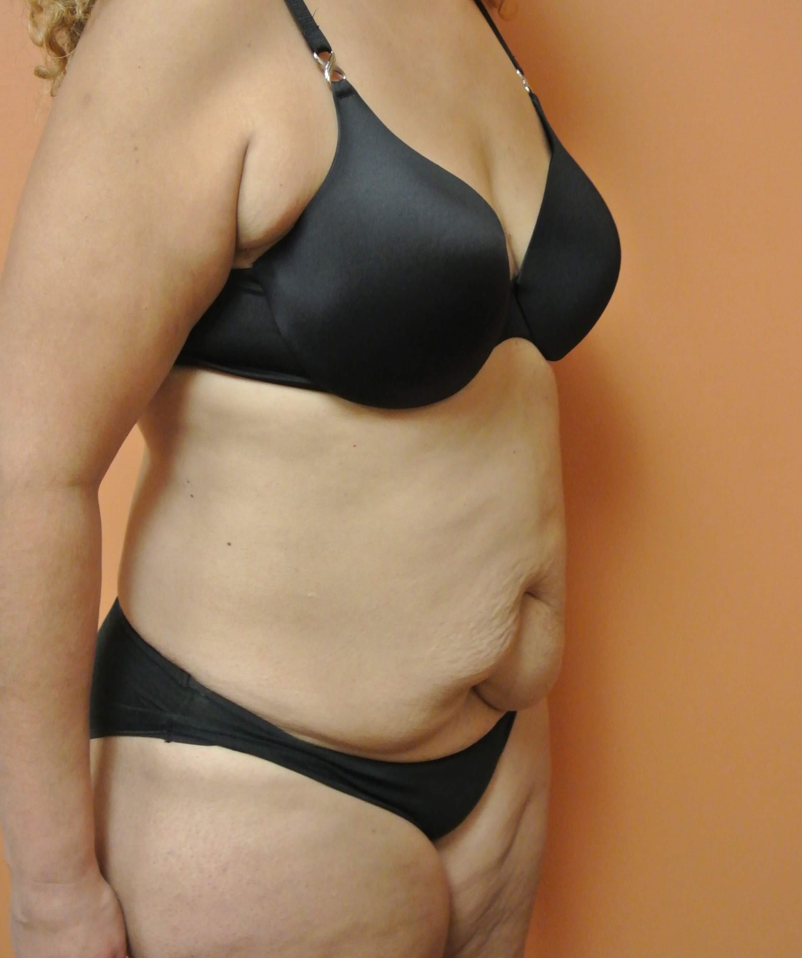 Scar Revision with Tummy Tuck Before