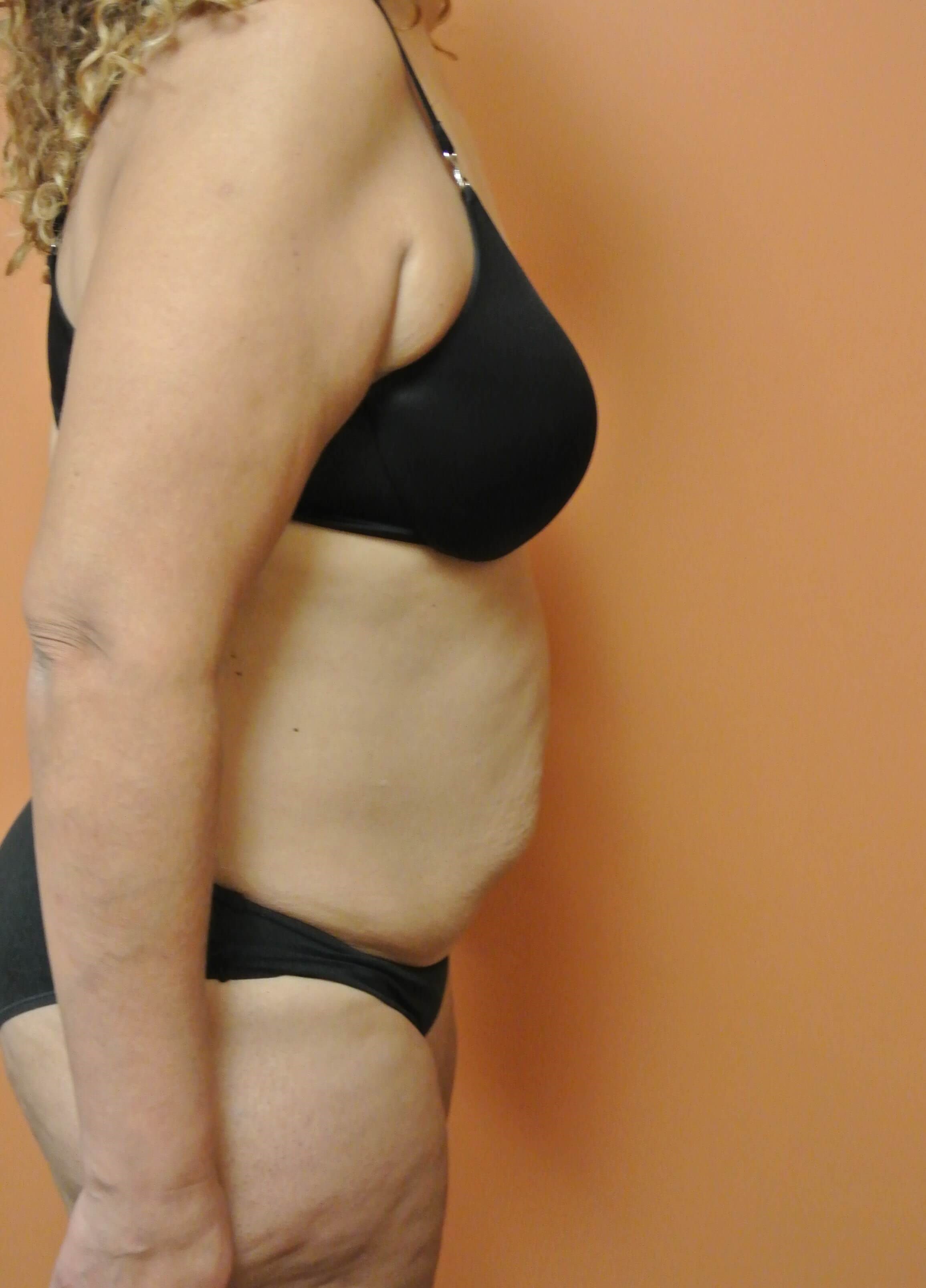 Scar Revision with Tummy Tuck Before