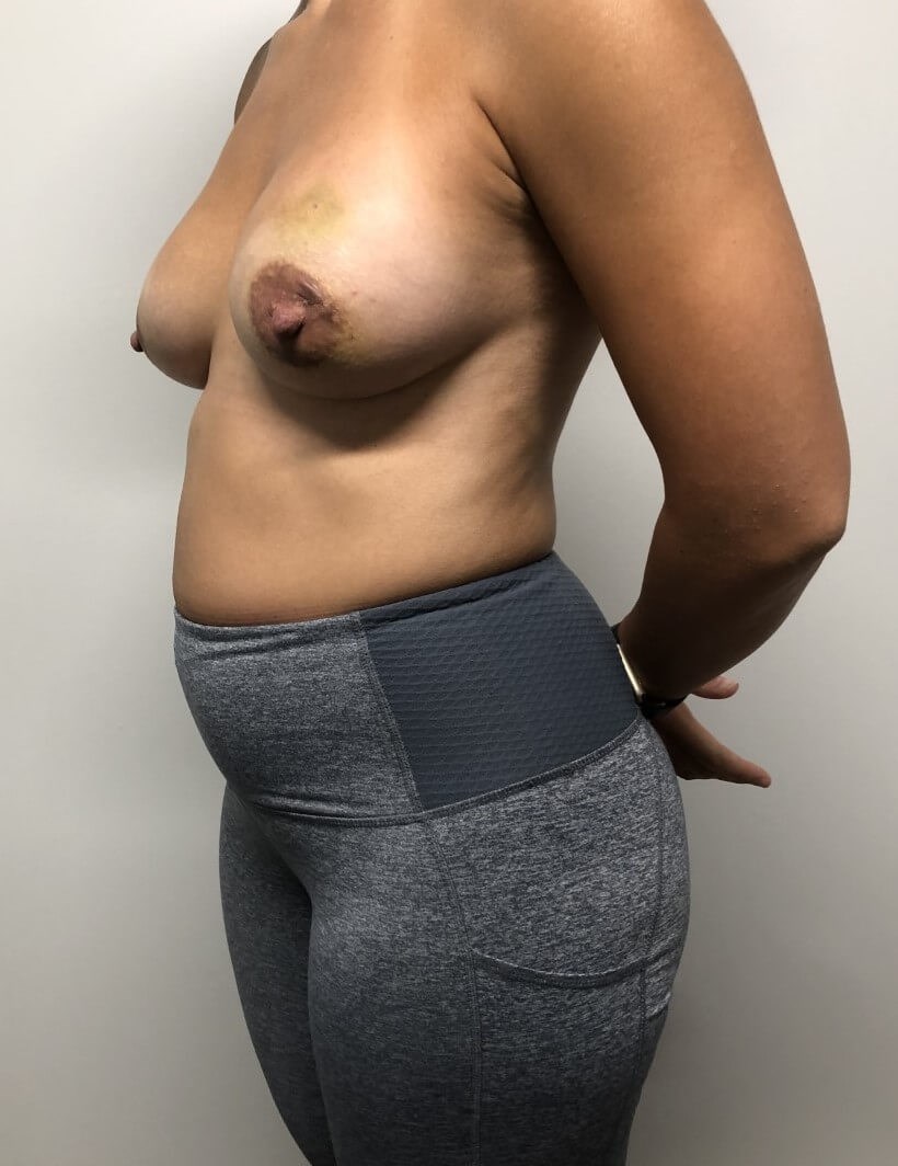 Skin Sparing Reconstruction Before