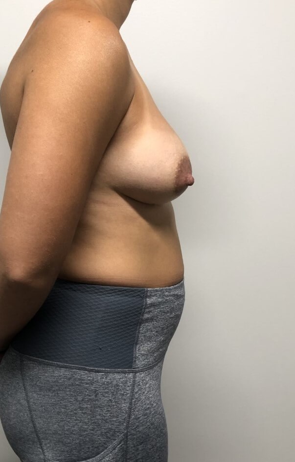 Skin Sparing Reconstruction Before