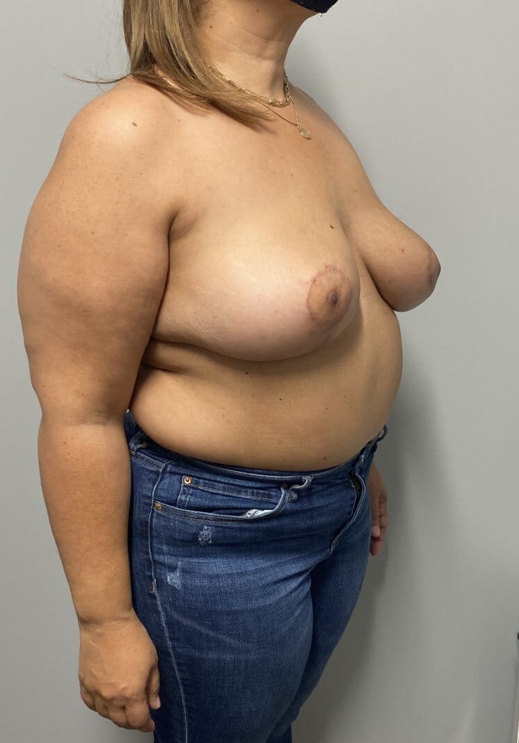 Oncoplastic Reduction & Lift After