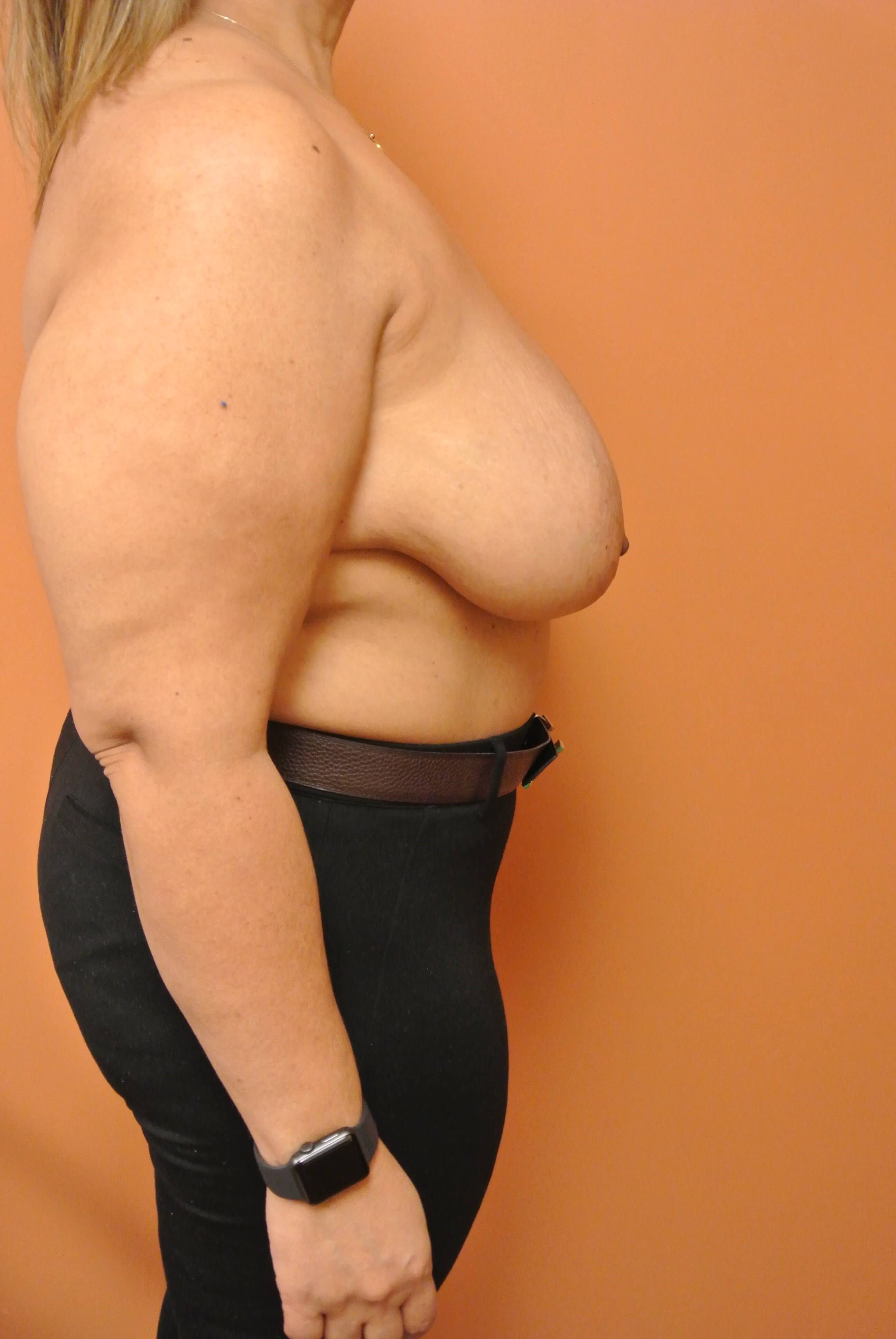 Oncoplastic Reduction & Lift Before