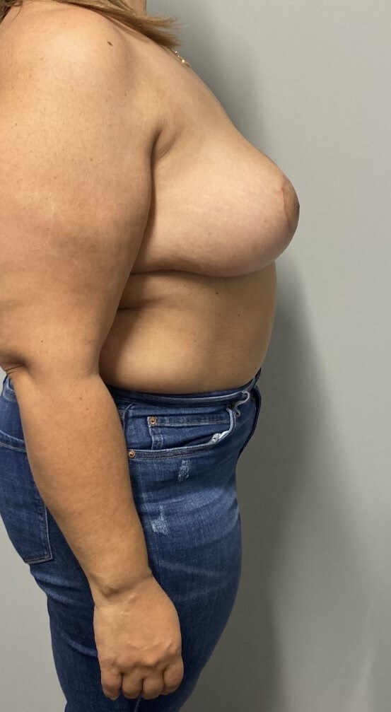Oncoplastic Reduction & Lift After