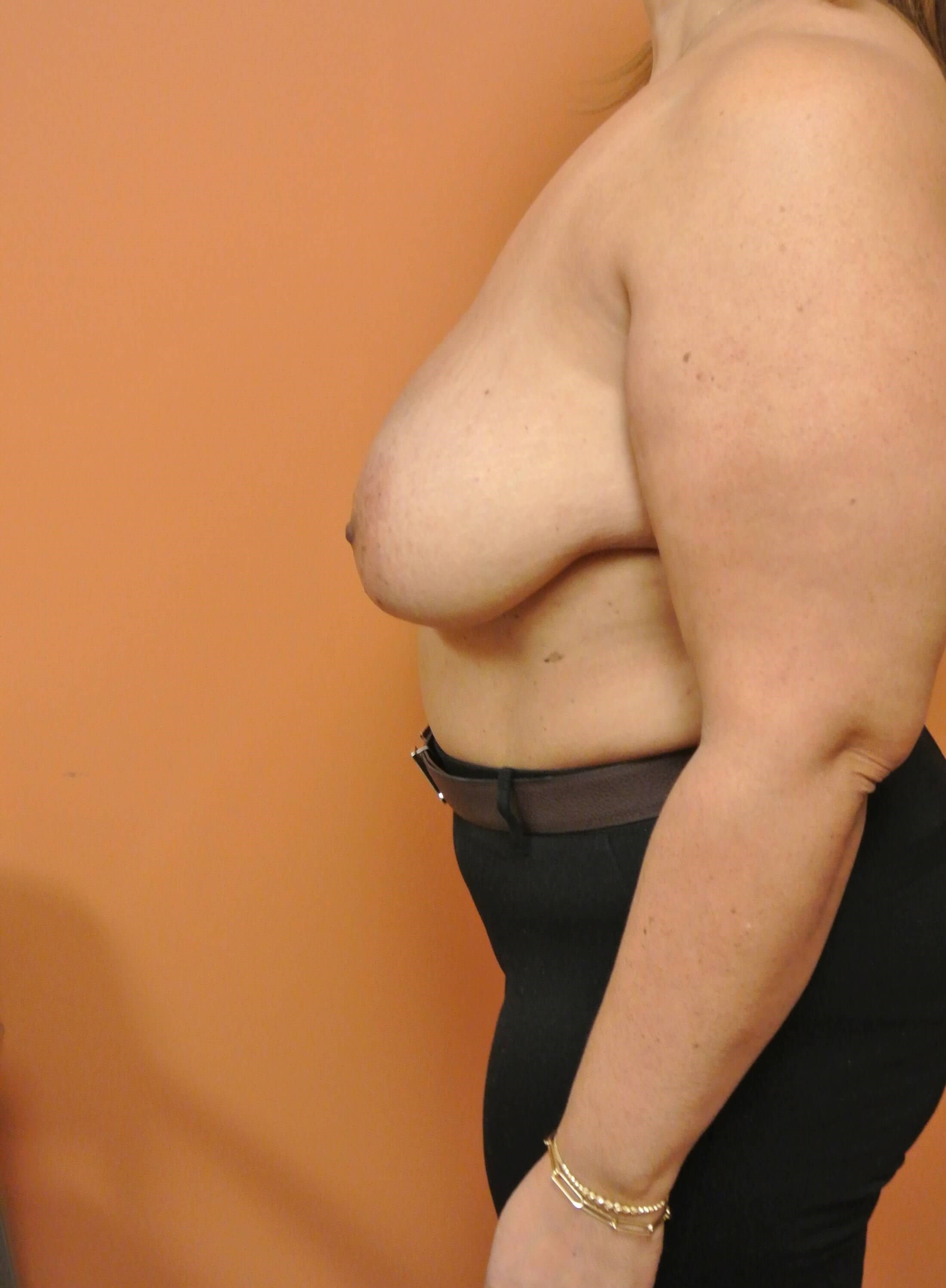 Oncoplastic Reduction & Lift Before