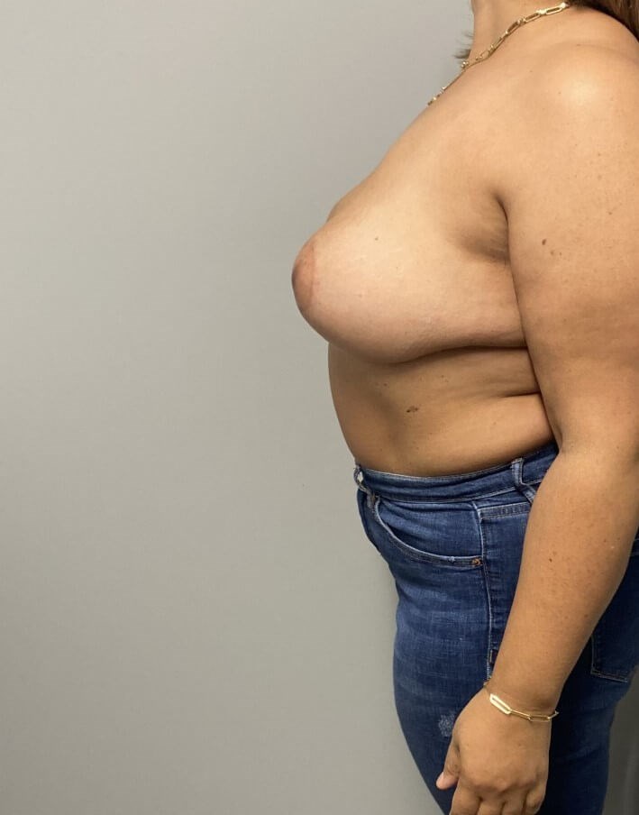 Oncoplastic Reduction & Lift After