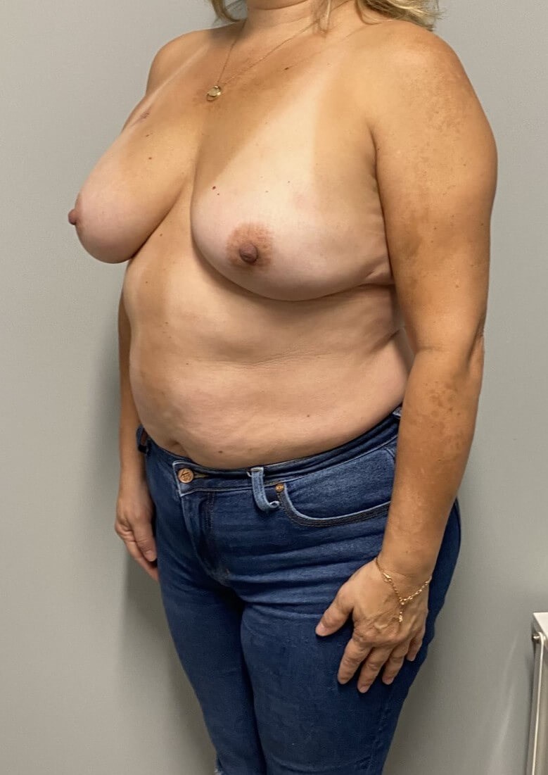 Breast Implant after Expander After