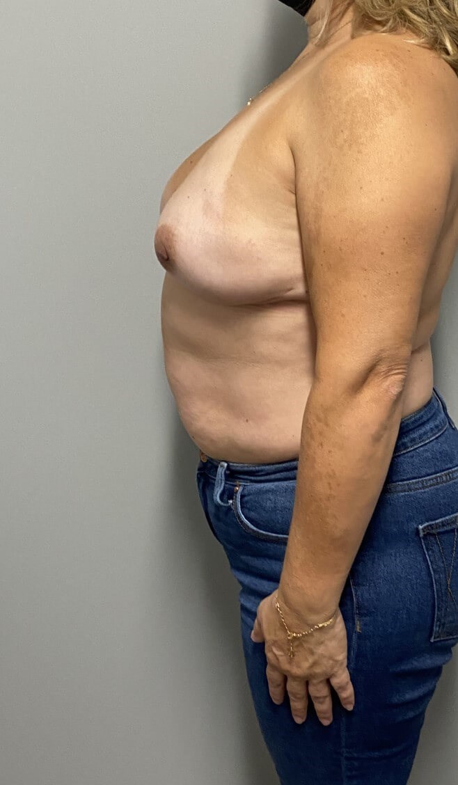 Breast Implant after Expander After