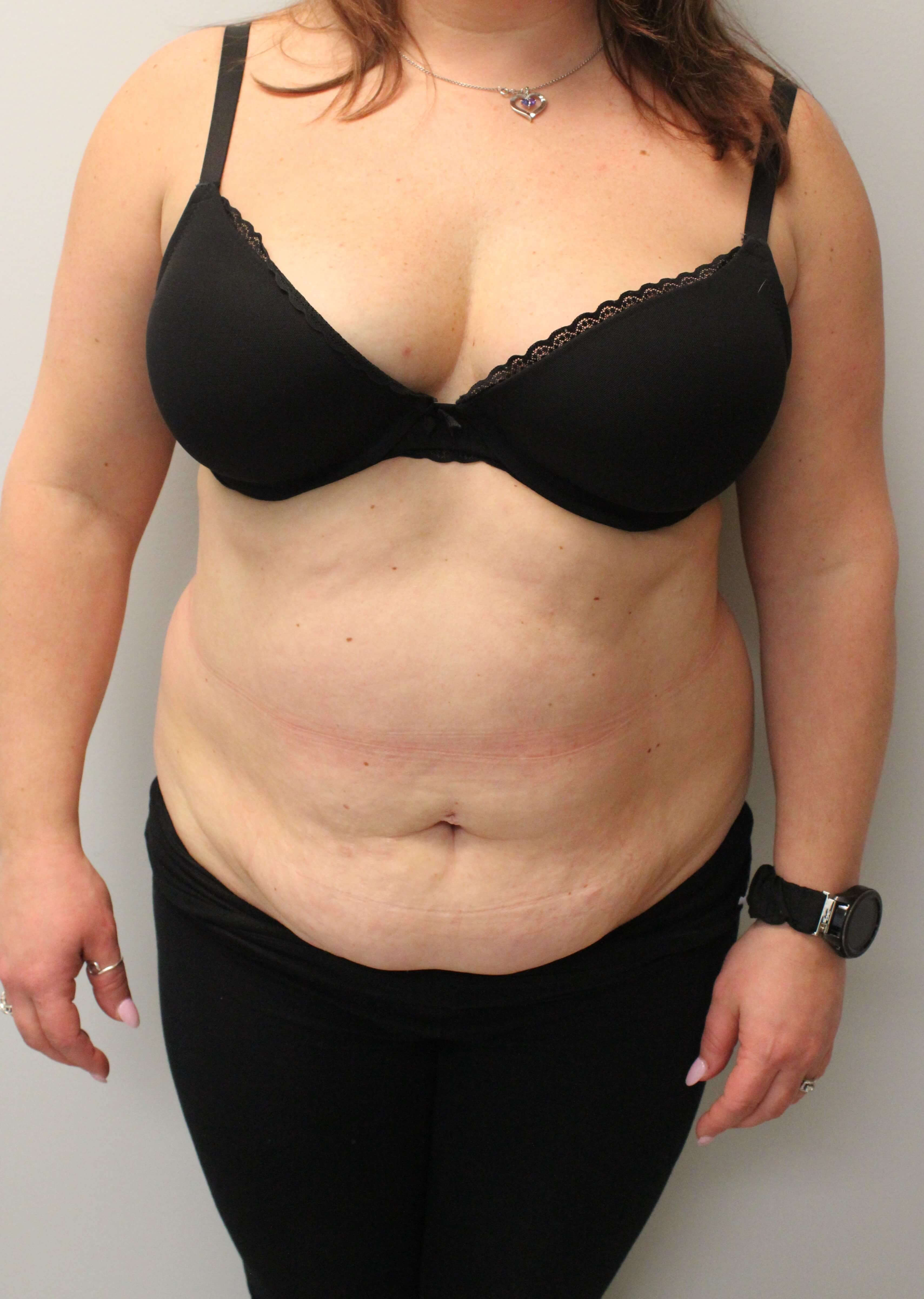 Tummy Tuck and Liposuction Before