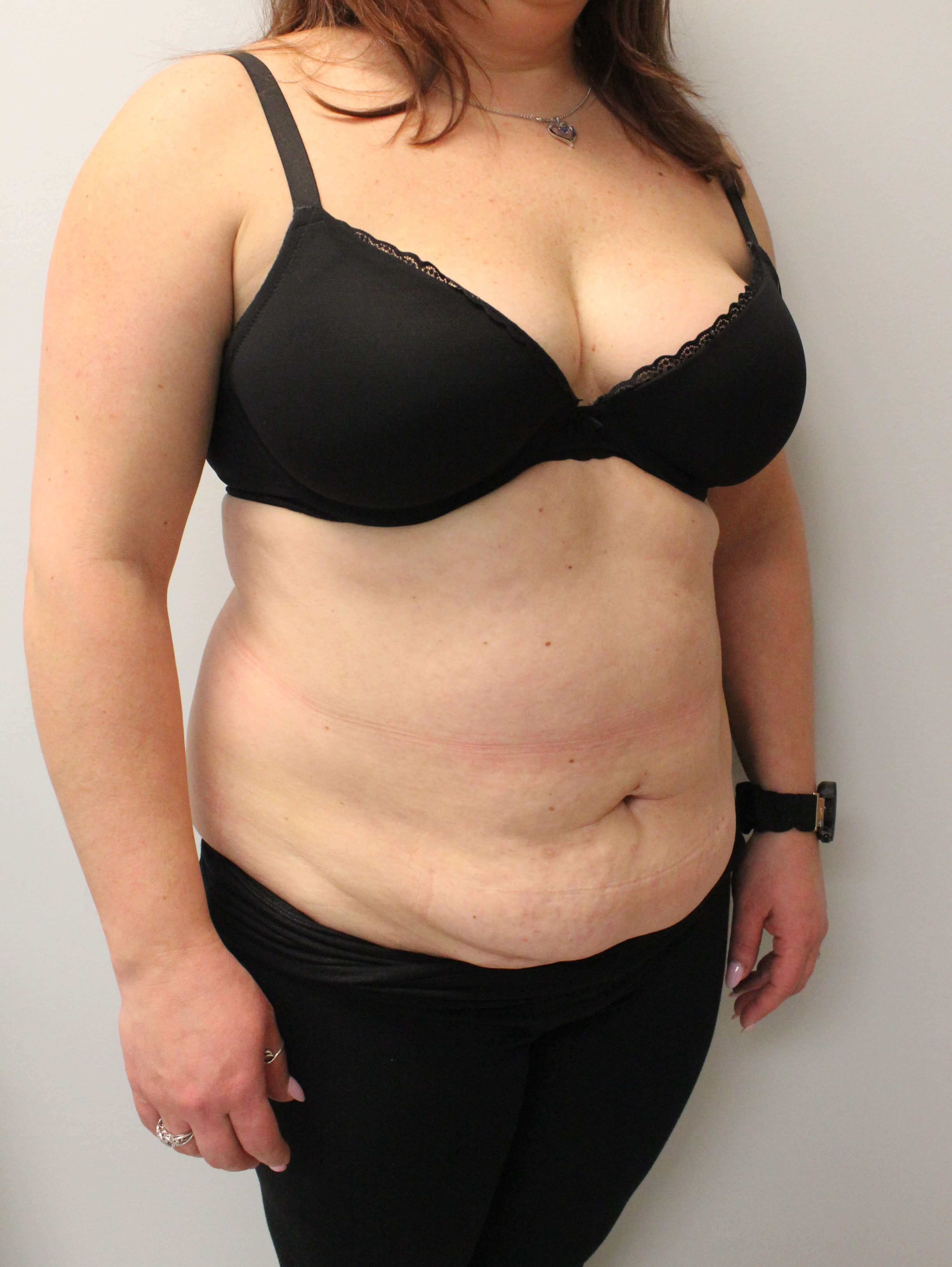 Tummy Tuck and Liposuction Before
