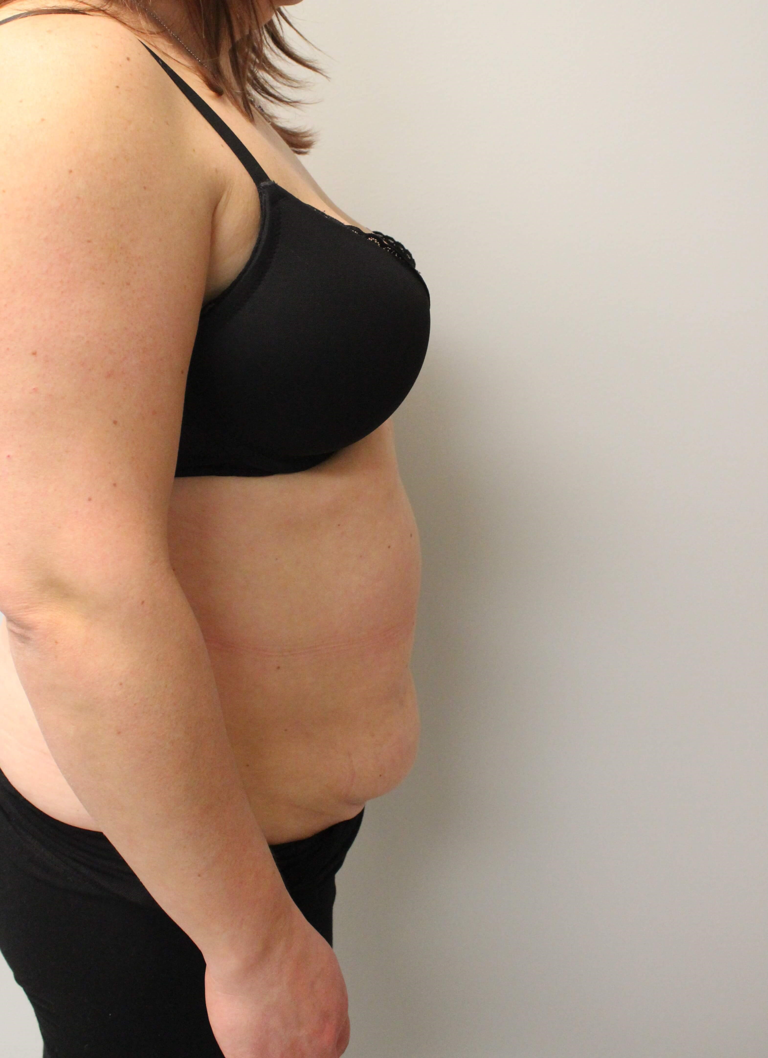 Tummy Tuck and Liposuction Before