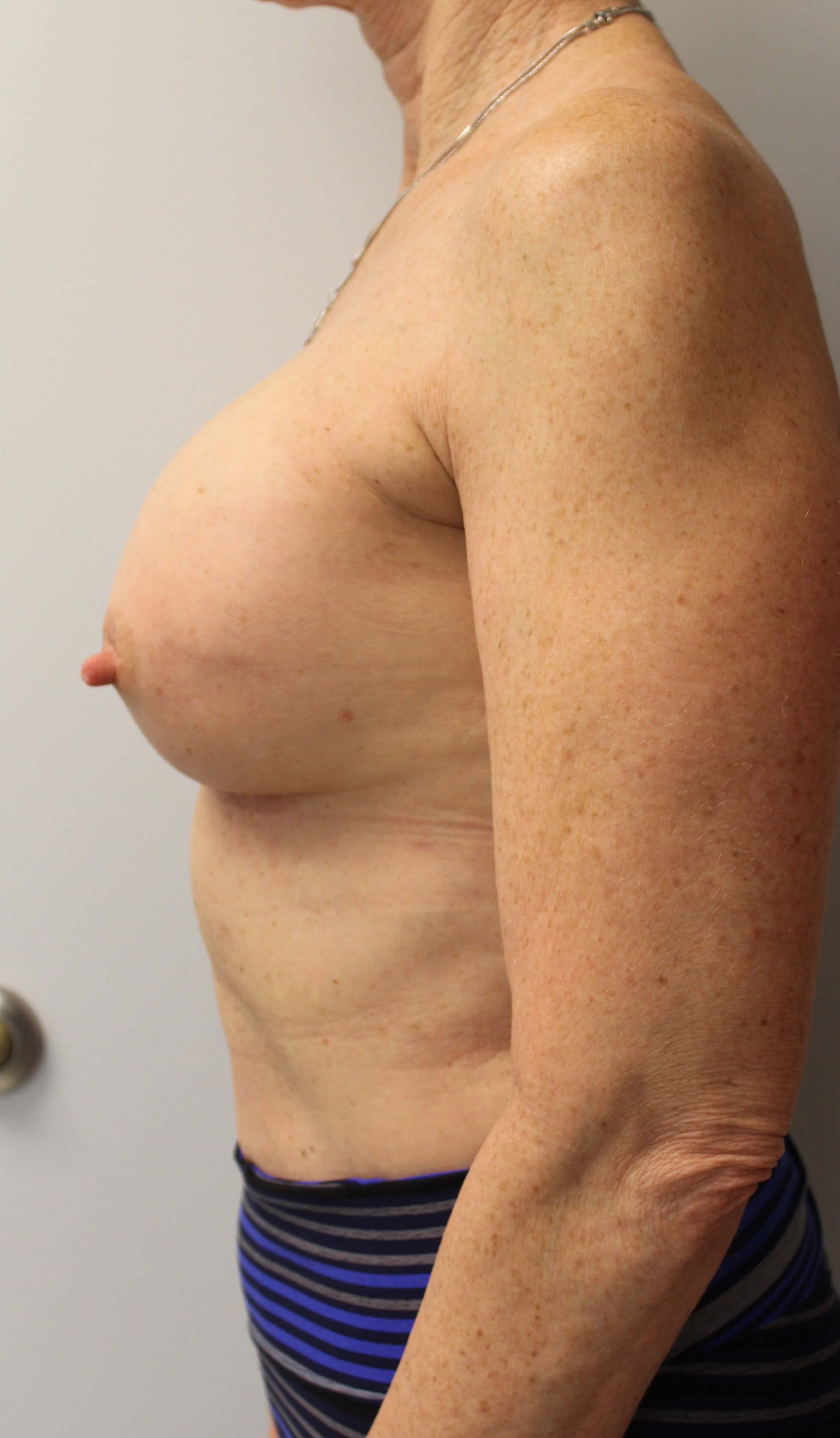 Direct Implant & Alloderm After