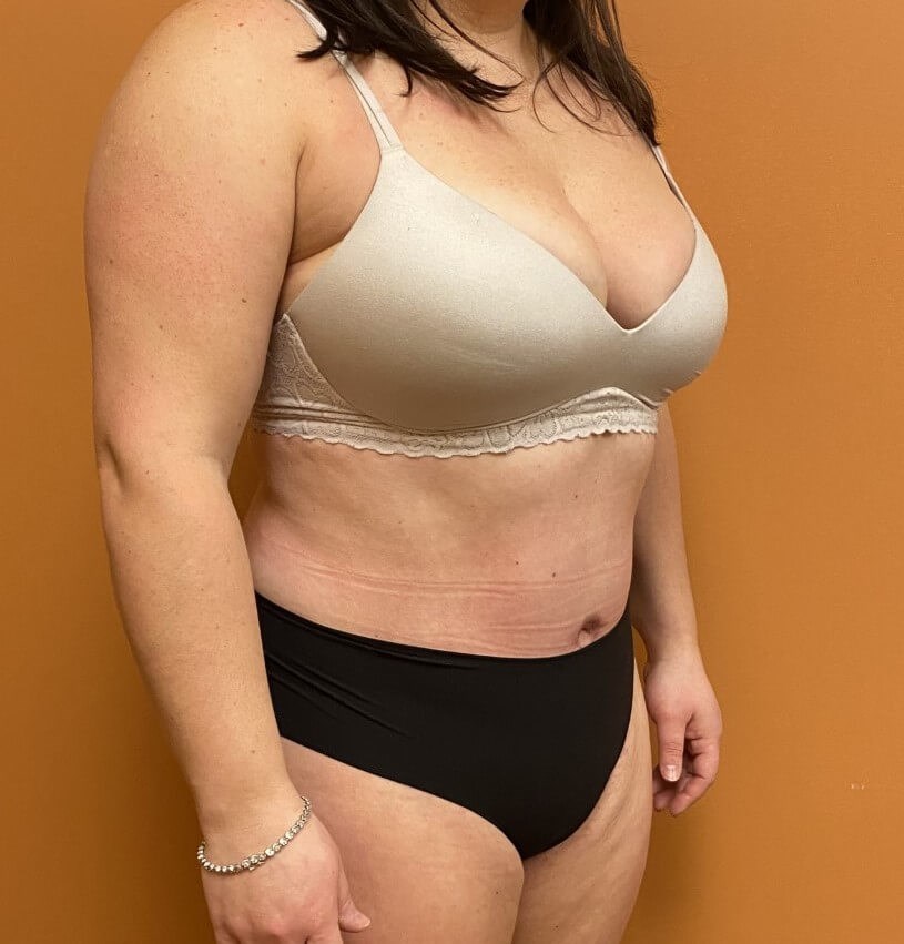 Tummy Tuck and Liposuction After