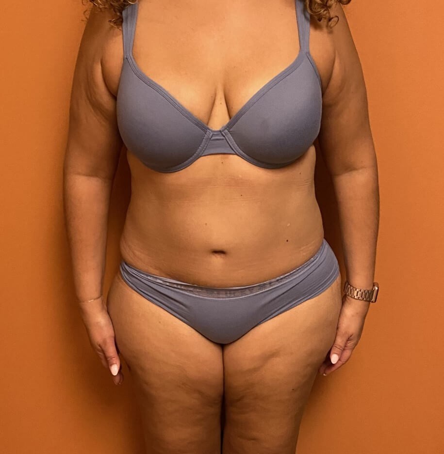 Scar Revision with Tummy Tuck After