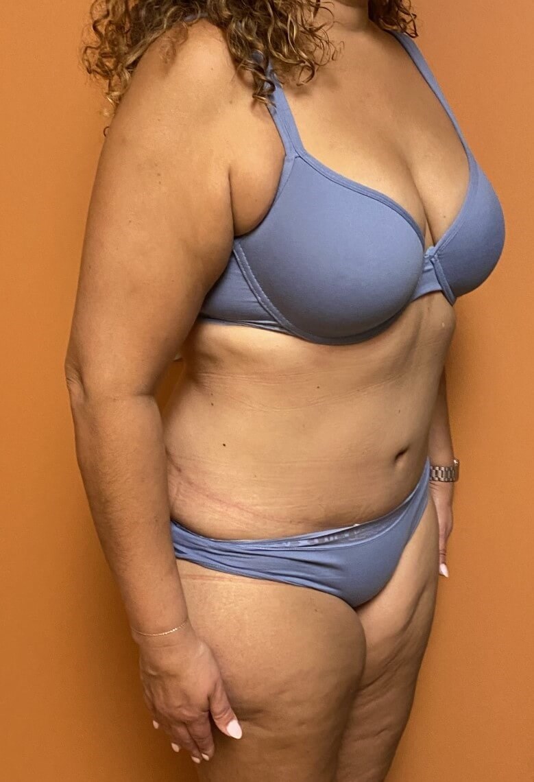 Scar Revision with Tummy Tuck After