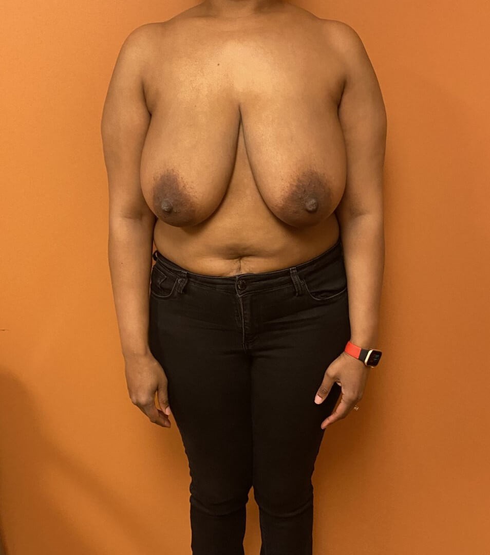 Breast Reduction Before