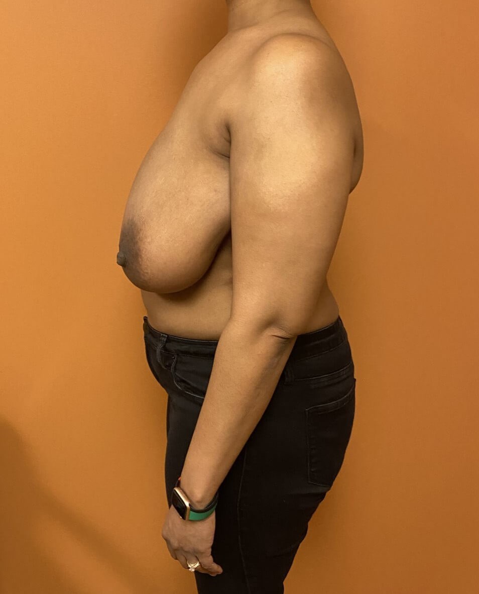 Breast Reduction Before