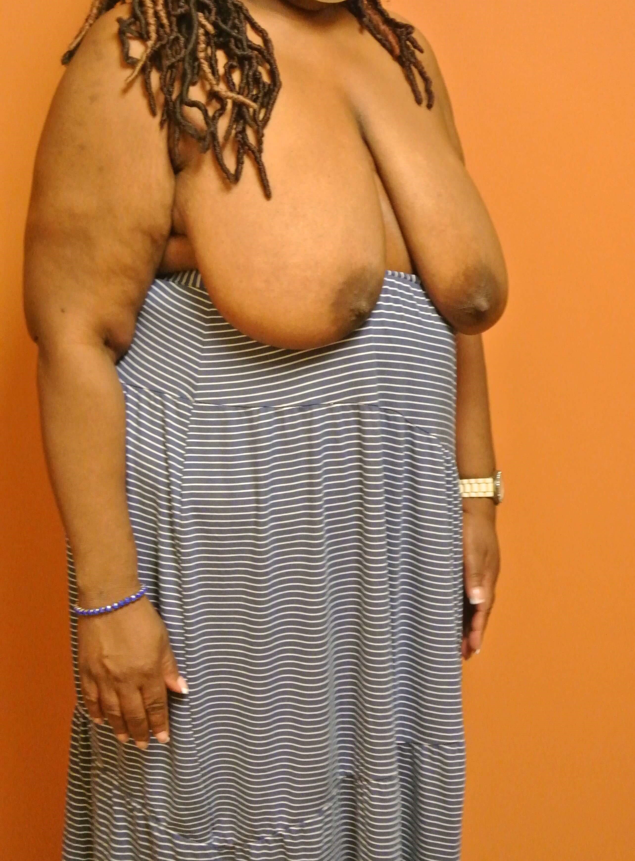 Breast Reduction Before