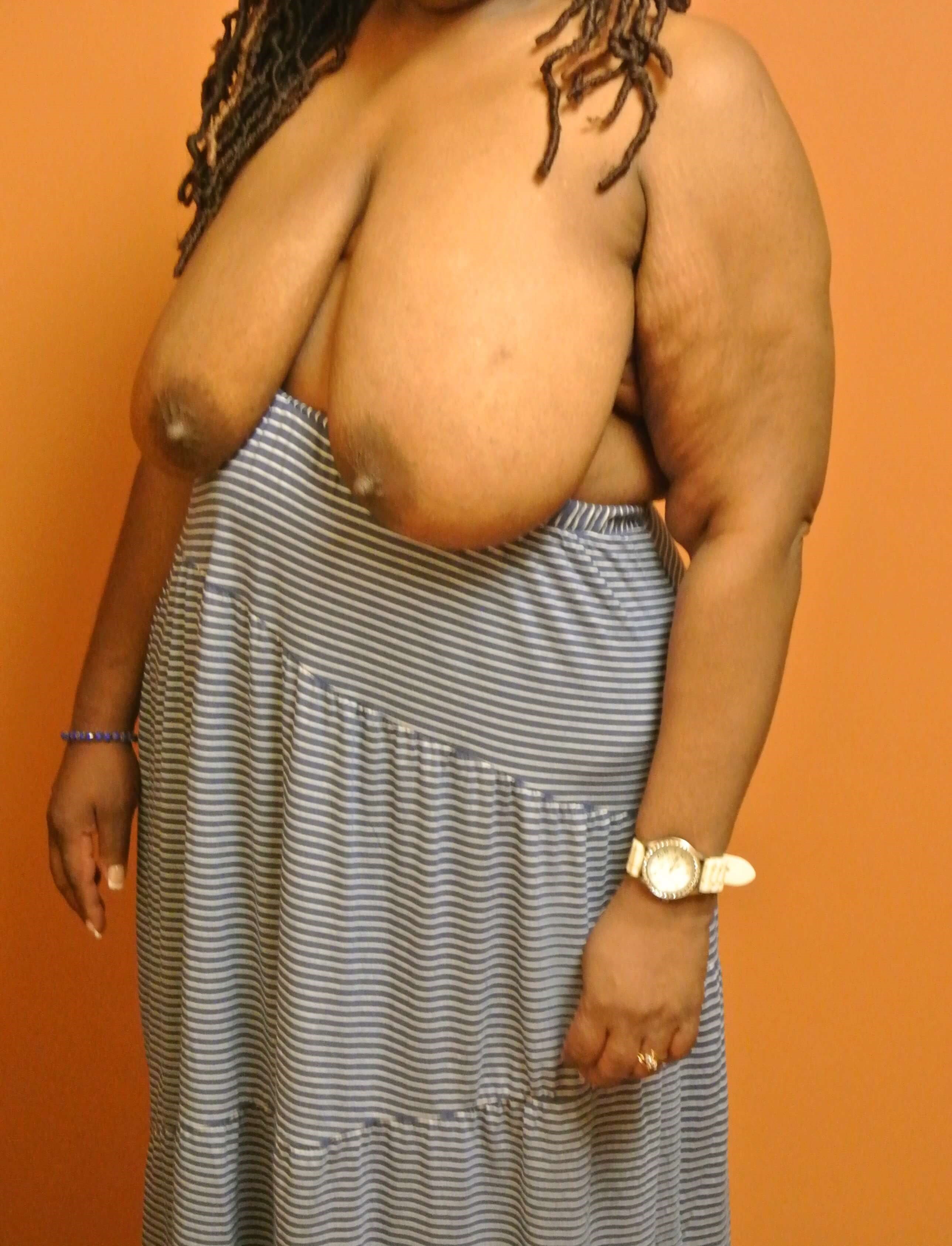 Breast Reduction Before