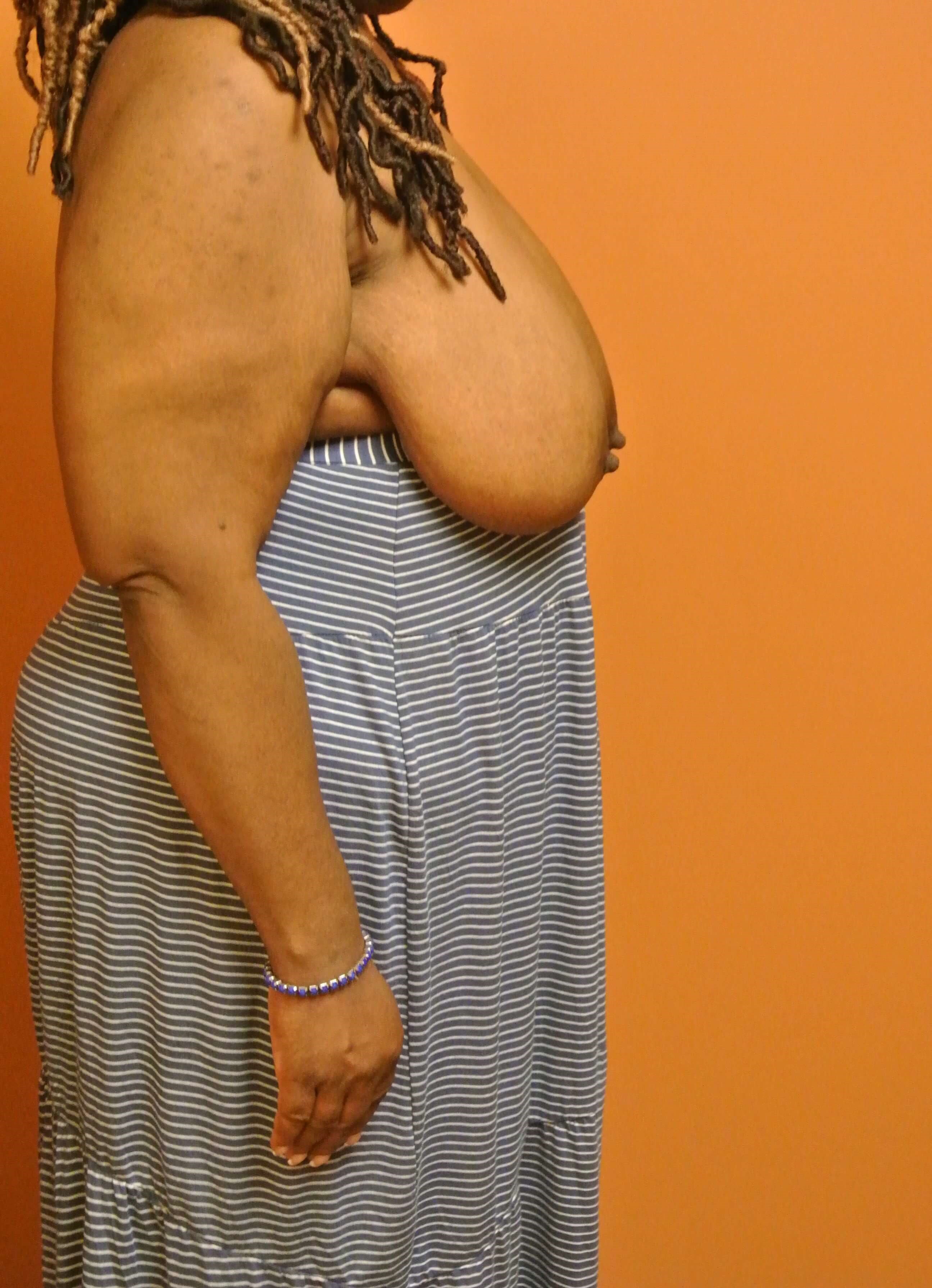 Breast Reduction Before