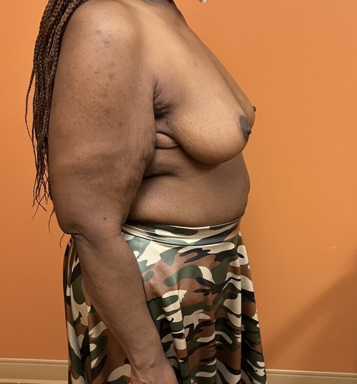 Breast Reduction After