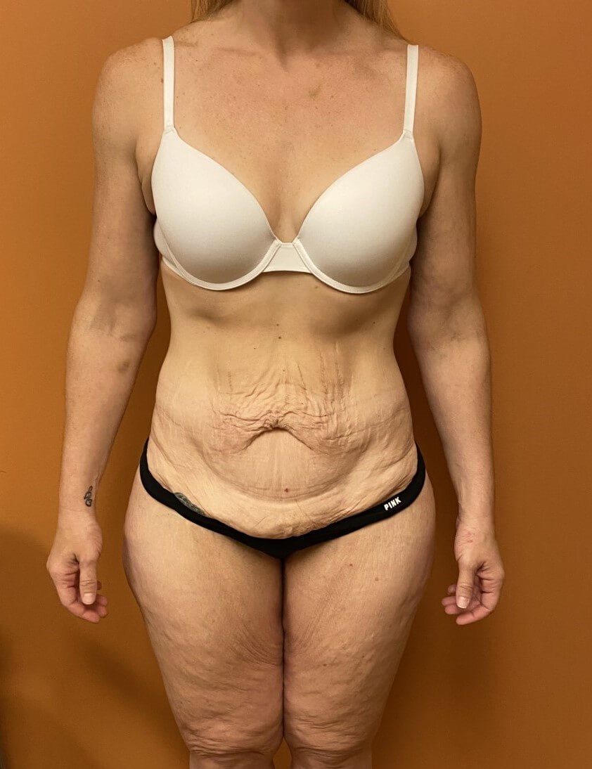 Tummy Tuck after weight loss Before
