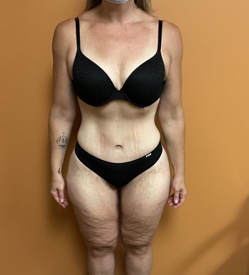 Tummy Tuck after weight loss After