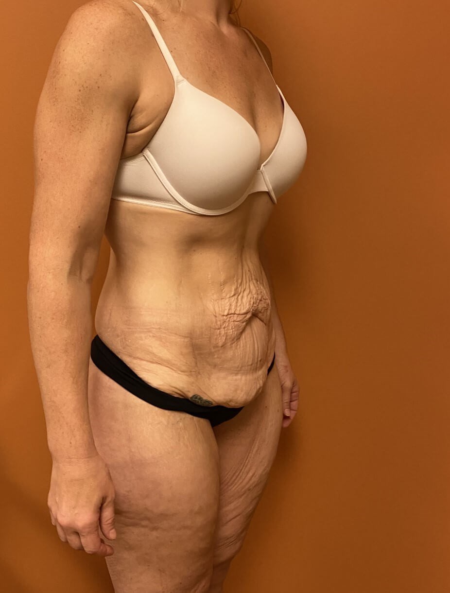 Tummy Tuck after weight loss Before