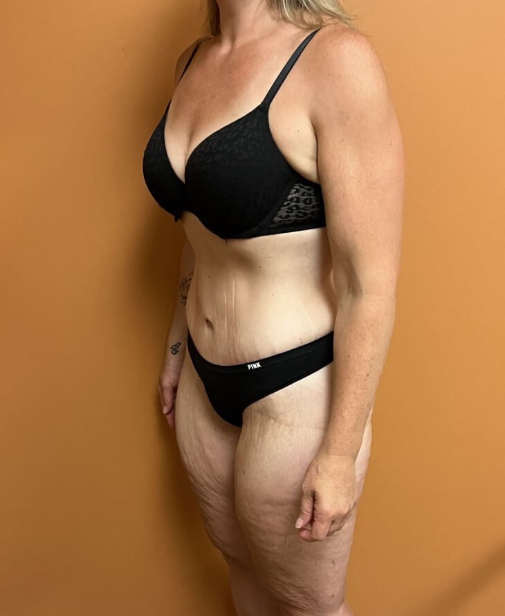 Tummy Tuck after weight loss After