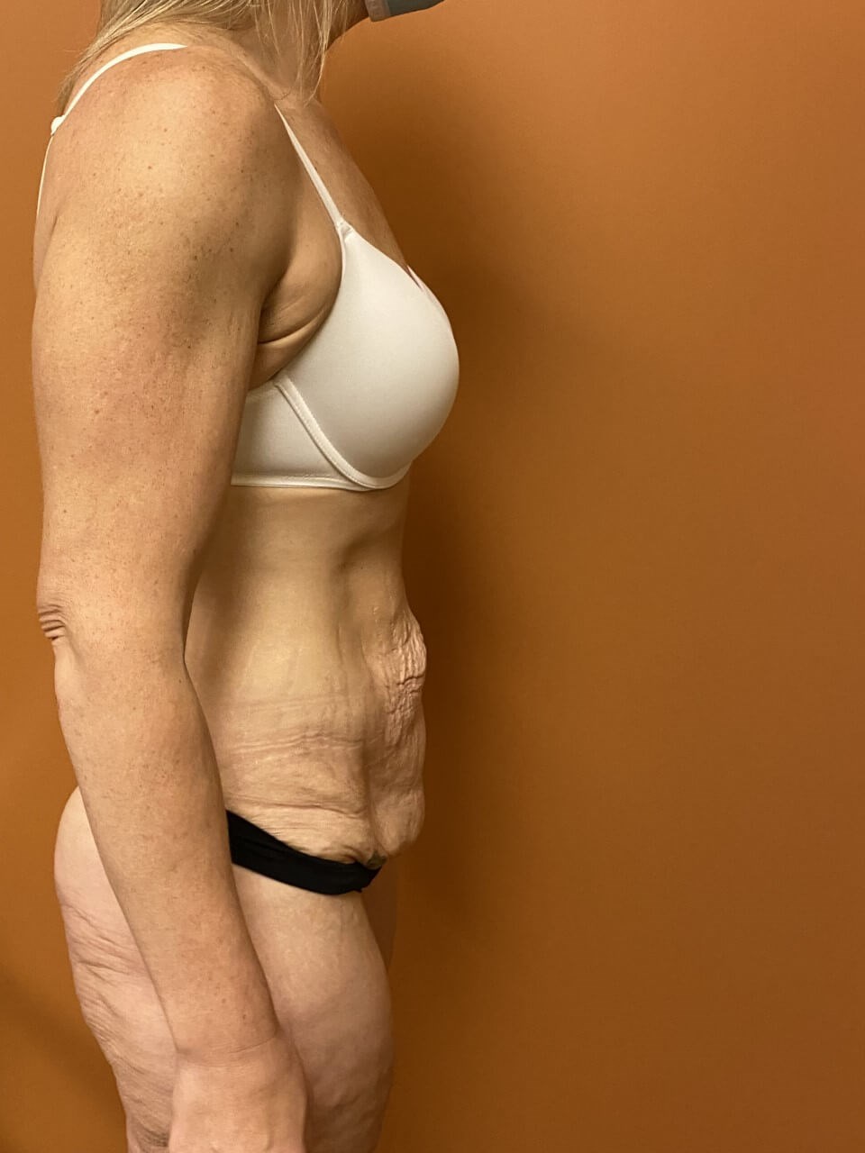 Tummy Tuck after weight loss Before