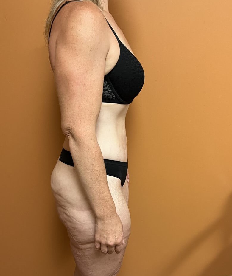 Tummy Tuck after weight loss After